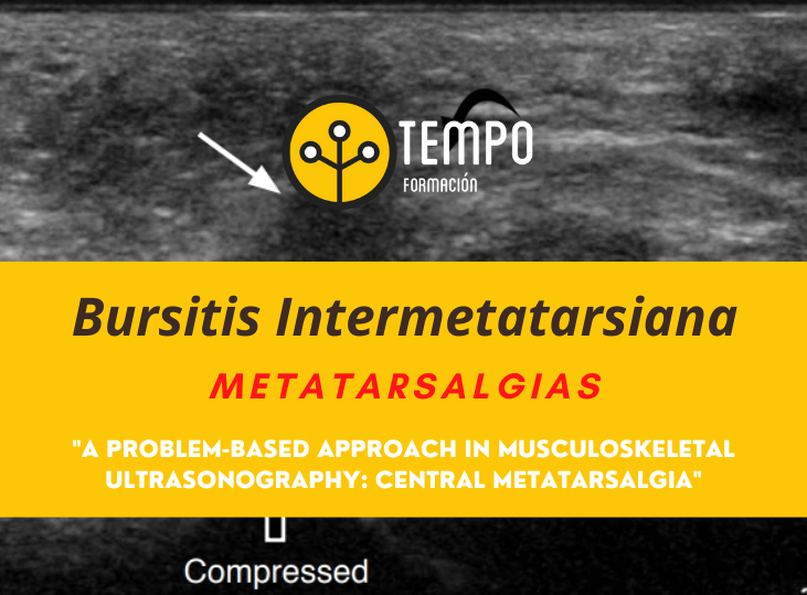 bursitis-intermetatarsiana-y-ecografia